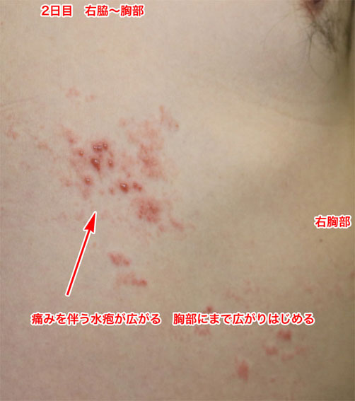 帯状疱疹 たいじょうほうしん の発病から治るまでの二ヶ月をメモと写真で紹介 サンデーゲーマーのブログwp