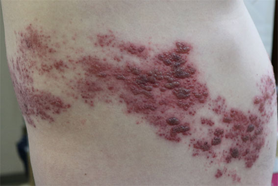 帯状疱疹 たいじょうほうしん の発病から治るまでの二ヶ月をメモと写真で紹介 サンデーゲーマーのブログwp